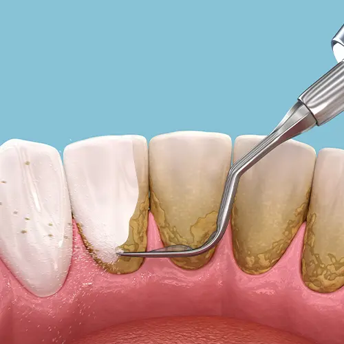 rendering-of-cleaning-the-backside-of-teeth