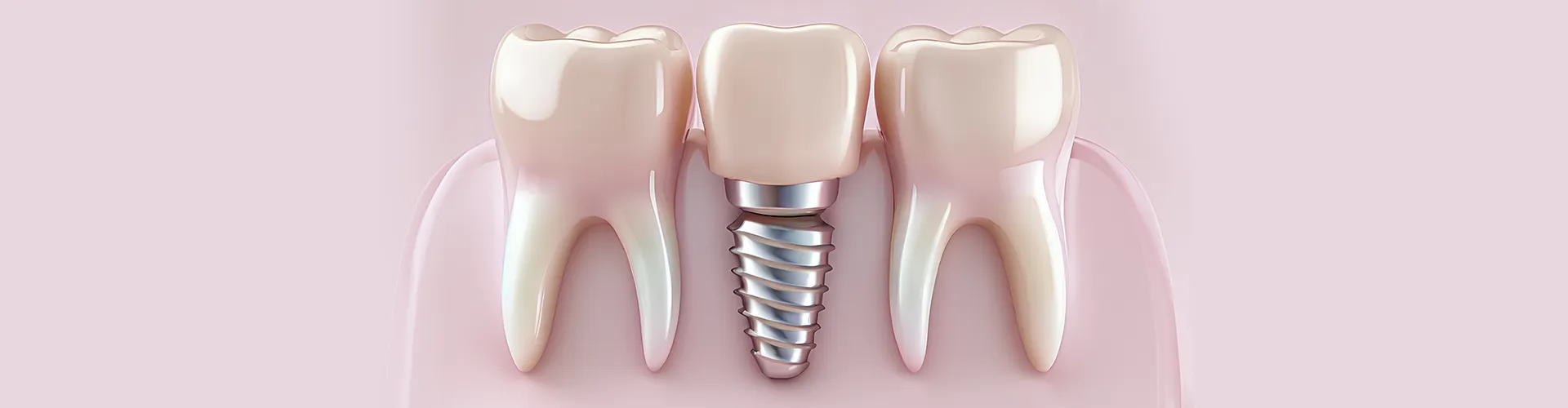 rendering of a dental implant between teeth