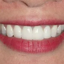 Before and after images of ruined teeth. These images show a result of the work of the dentist.