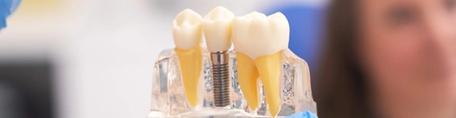 Showing Dental Implants