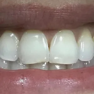 Before and after images of ruined teeth. These images show a result of the work of the dentist.