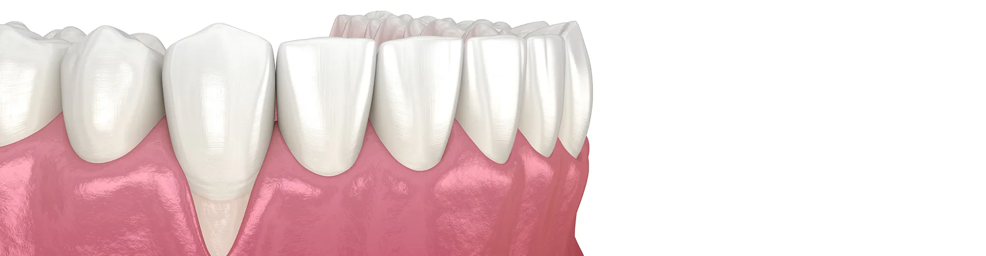 rendering of receding gums