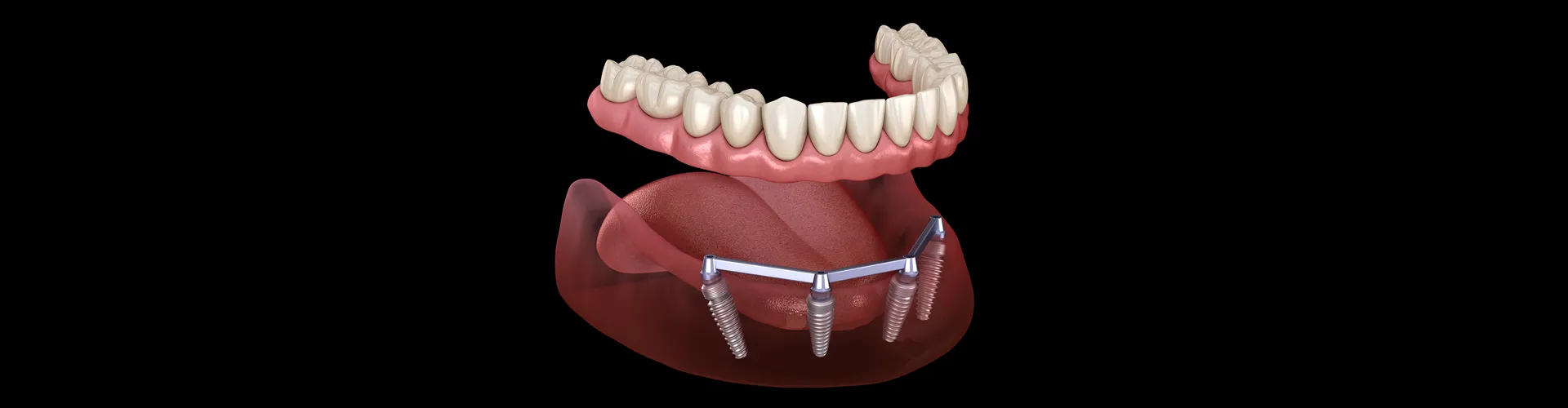 All on 4 Implant Illustration