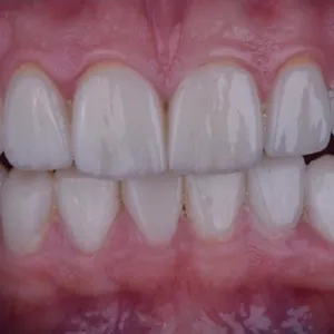 Before and after images of ruined teeth. These images show a result of the work of the dentist.