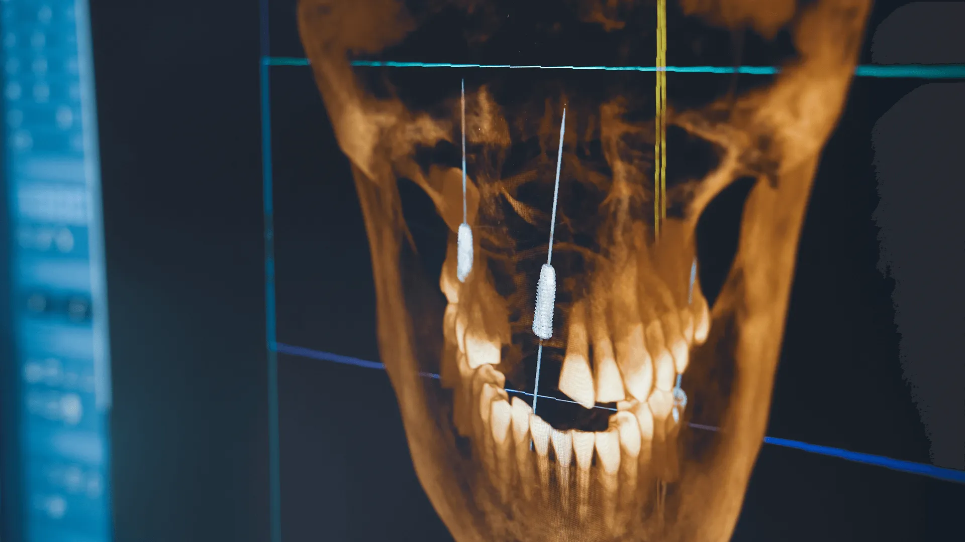 Dental implant X-rays