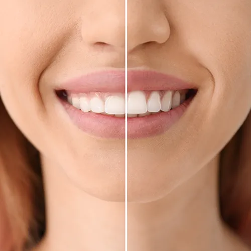 split photo of the before and after effects of tooth reshaping on a woman's smile