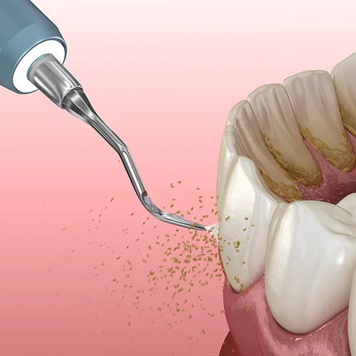 rendering of a water flosser removing buildup from teeth