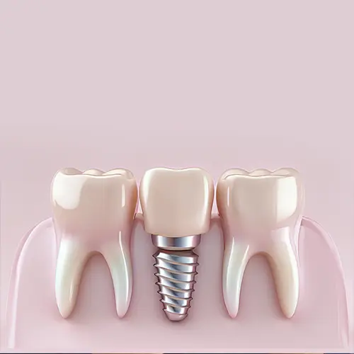 rendering of a dental implant between teeth