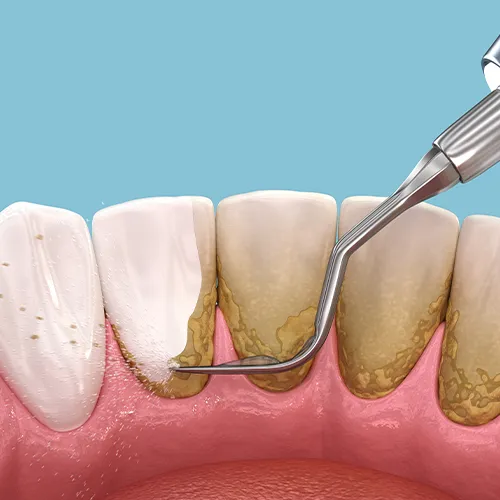 rendering-of-cleaning-the-backside-of-teeth