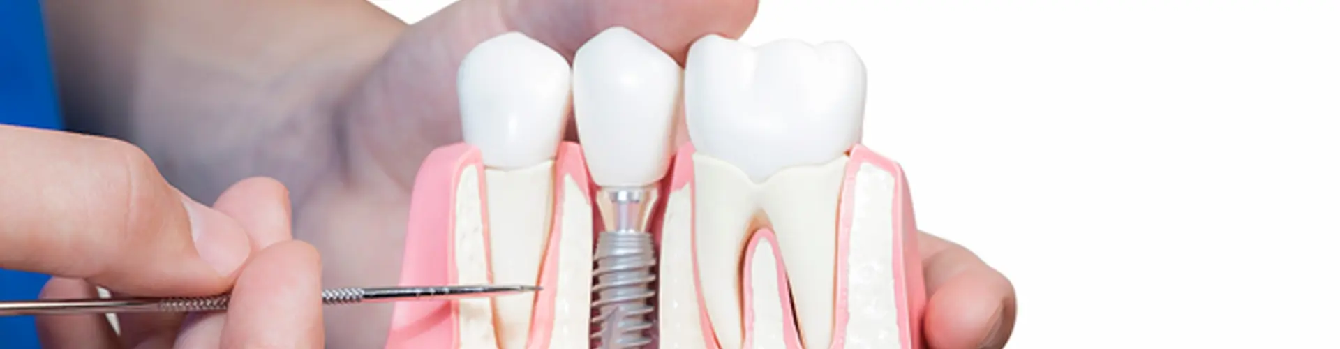 Showing Dental Implants