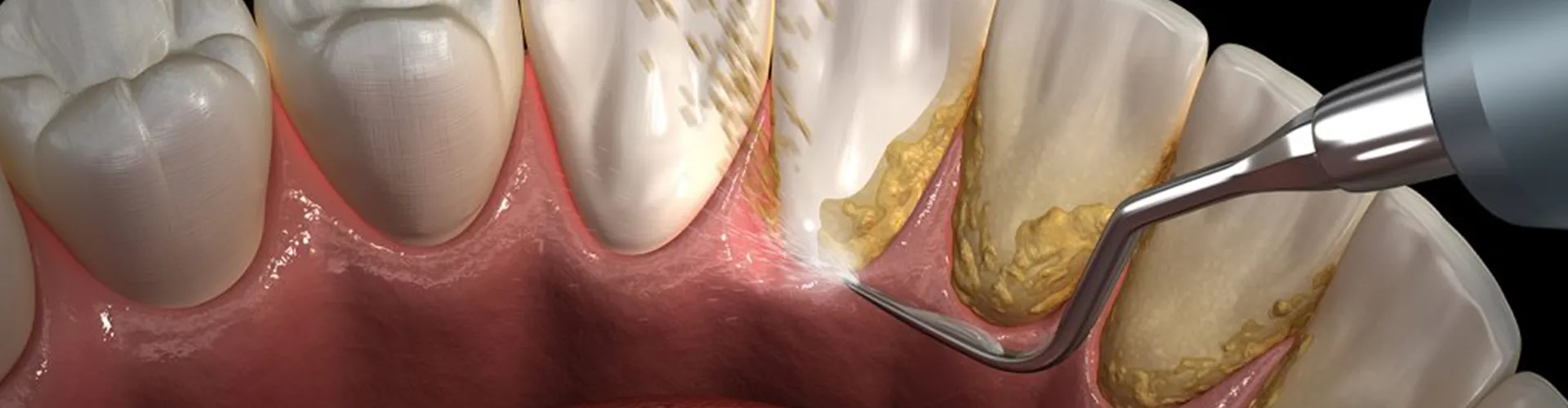 Backside of teeth being cleaned