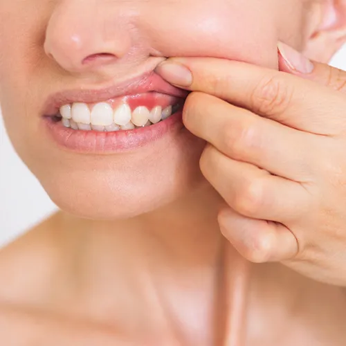 Woman lifting her lip to show gums.