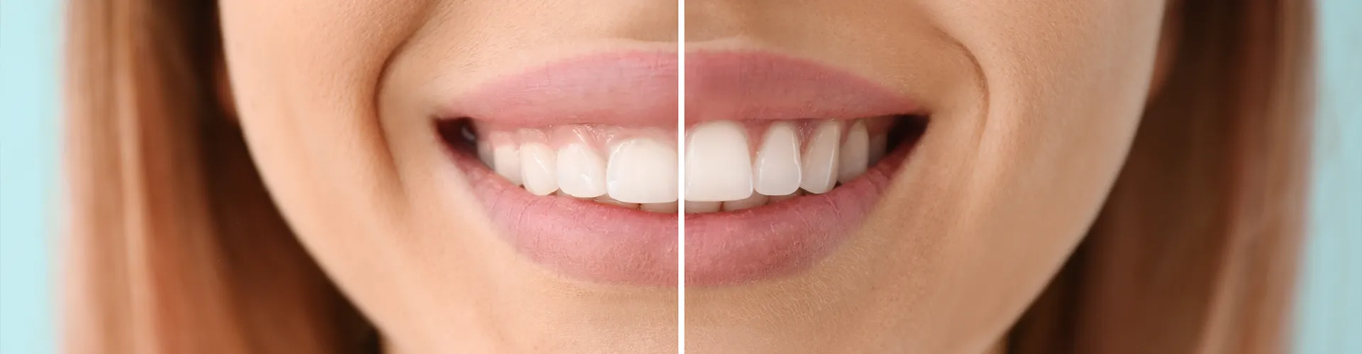 split photo of the before and after effects of tooth reshaping on a woman's smile