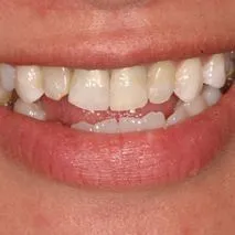 Before and after images of ruined teeth. These images show a result of the work of the dentist.