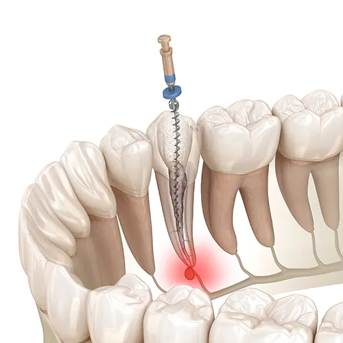 rendering of a root canal tool in a tooth