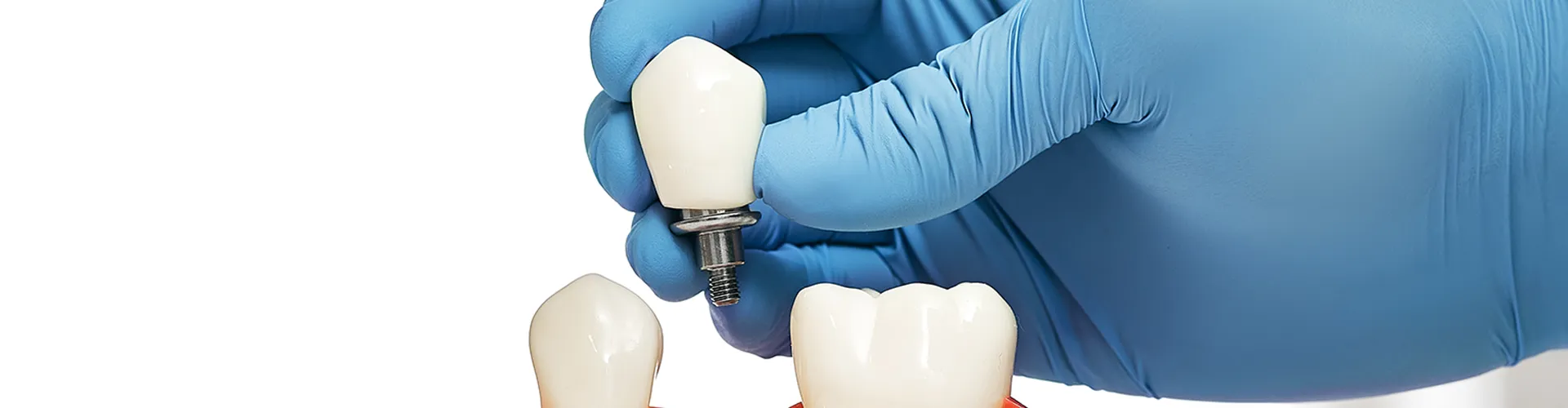 Hand placing an implant tooth