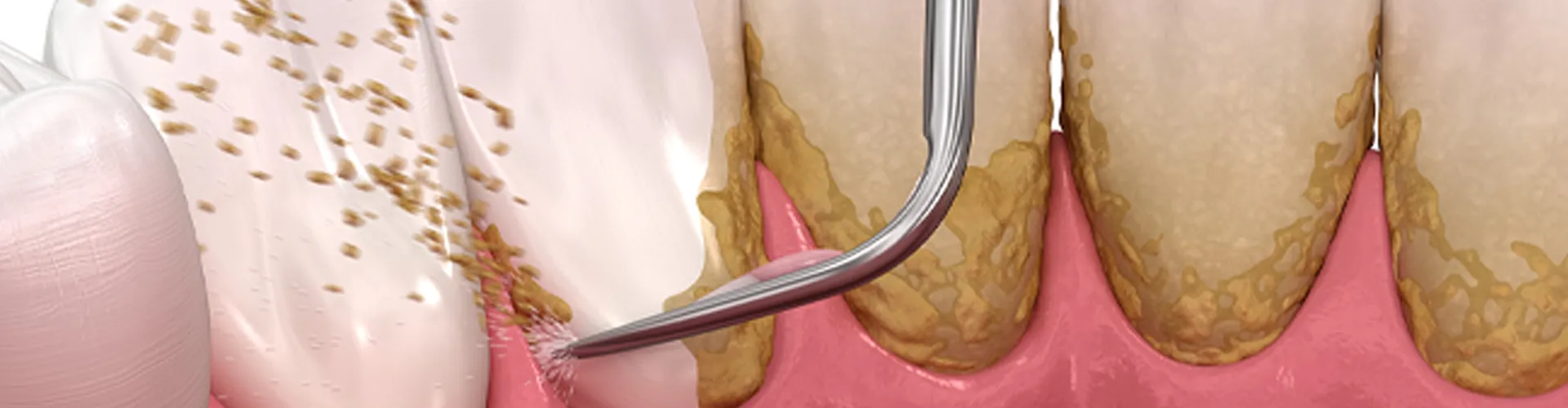 Periodontal Disease Illustration