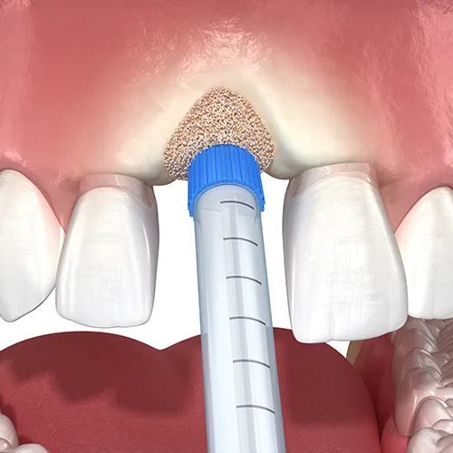 rendering of a graft being placed into tooth socket