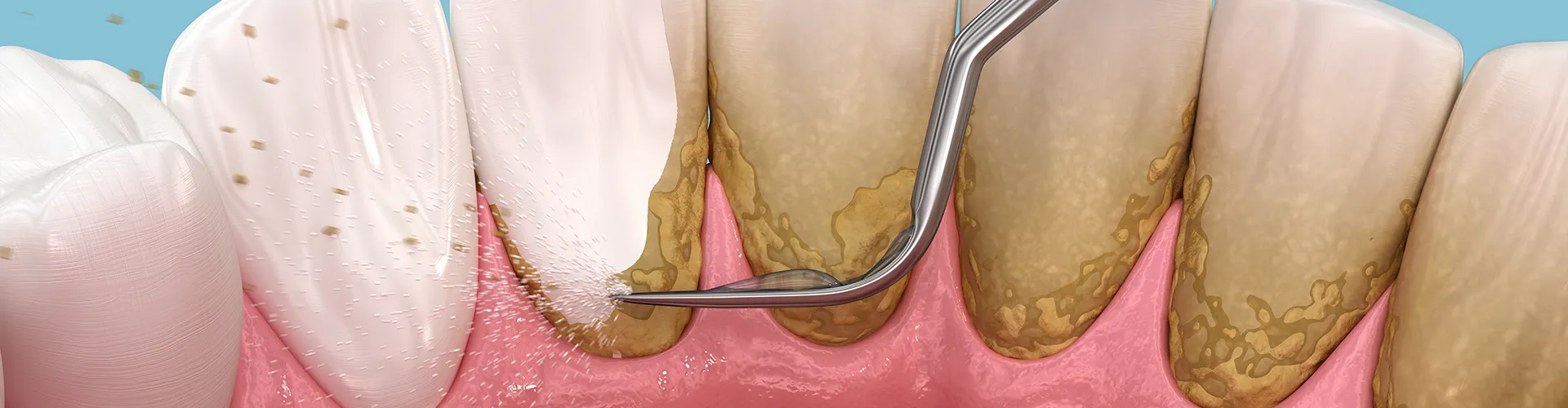 rendering-of-cleaning-the-backside-of-teeth