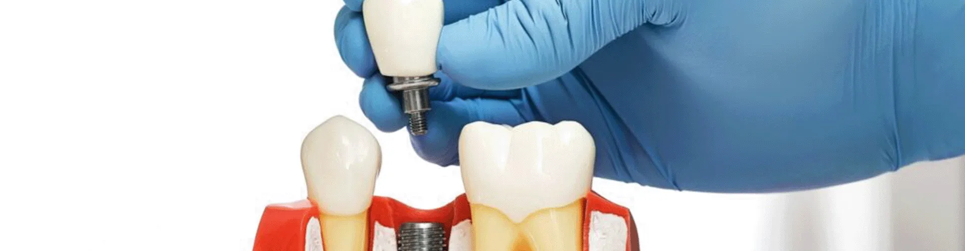 Dental implant depiction