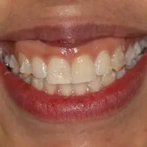 Before and after images of ruined teeth. These images show a result of the work of the dentist.