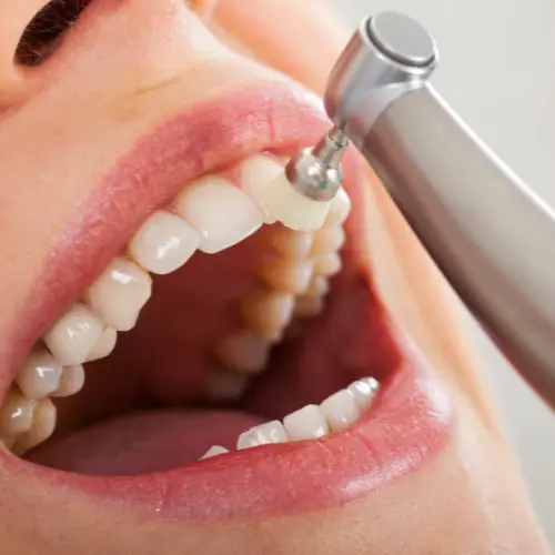 teeth cleaning tool being used on woman's teeth