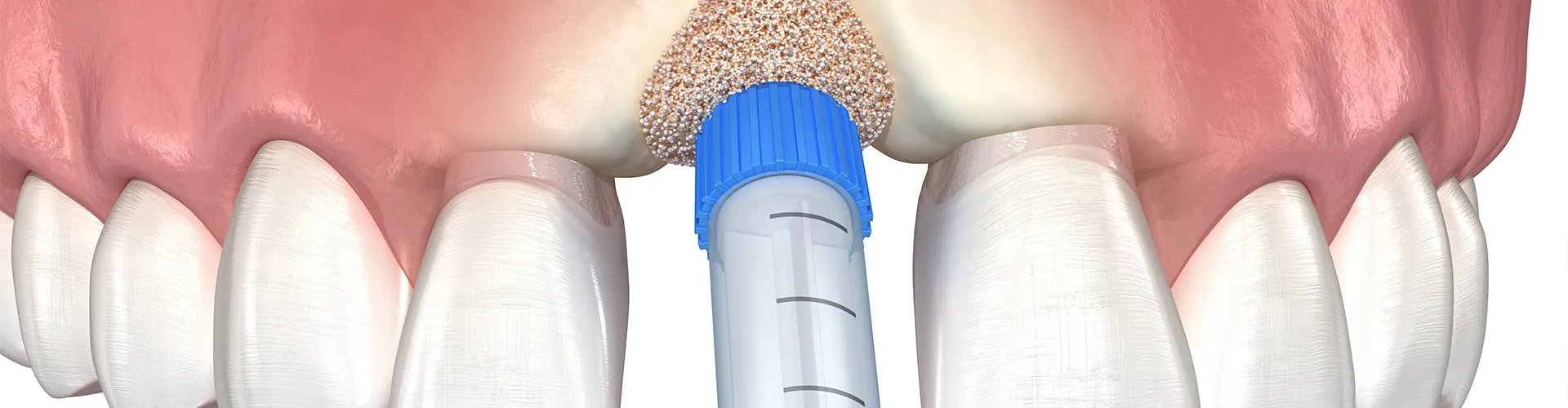 rendering of a graft being placed into tooth socket